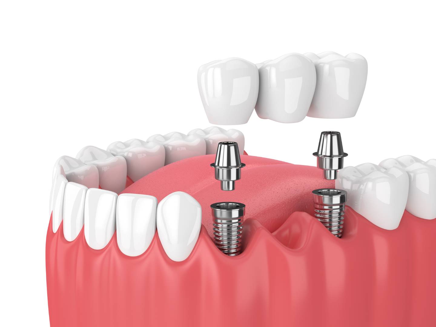 Tip 1 dental kemik içi implant satın alınacaktır